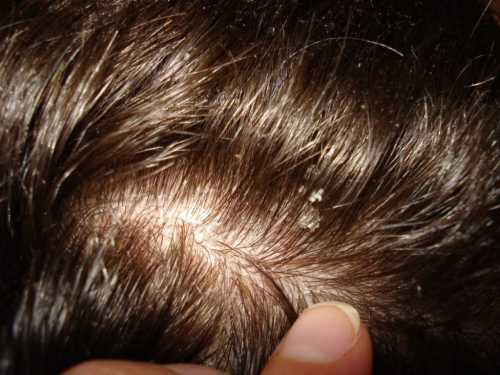 Как на здоровье волос влияют инфекции
