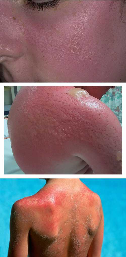 Аллергия на солнце: симптомы и лечение