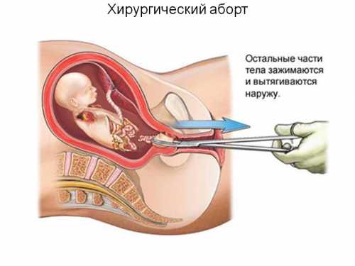 Солевой аборт заключается в том, что в околоплодный пузырь вводят едкий раствор, который обездвиживает плод в течение часов